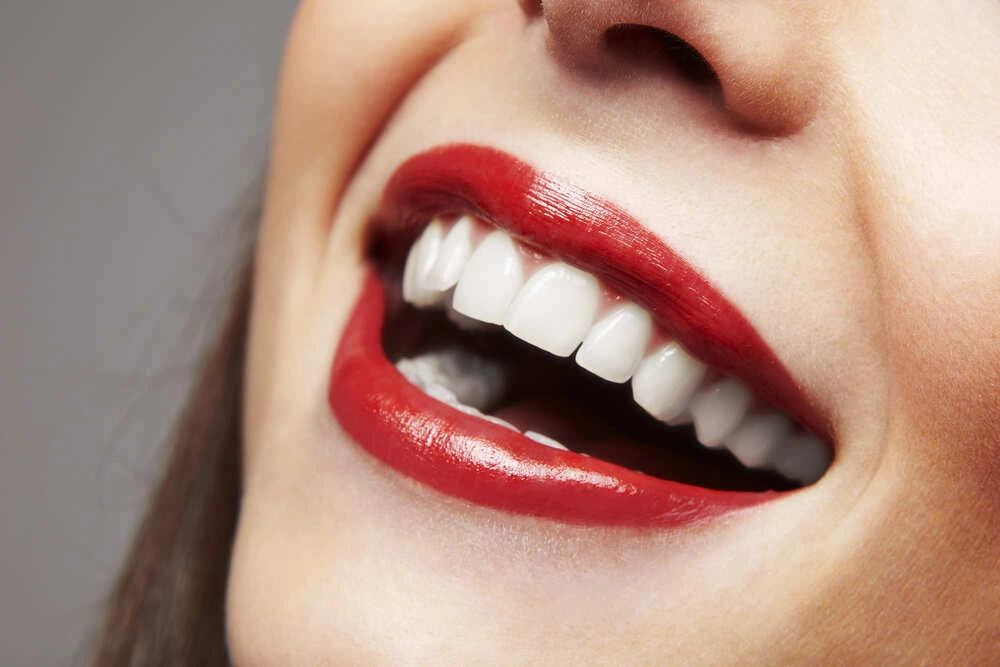 Carillas dentales